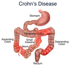Crohn's Disease – Kids Tummies Website